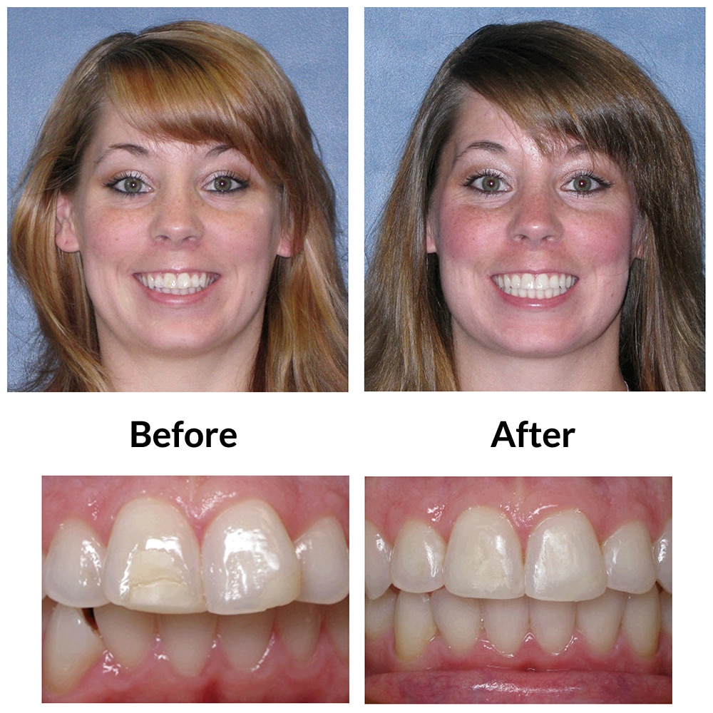 Invisalign Clear Braces Treatment for an Overbite in NYCDr. Jacquie