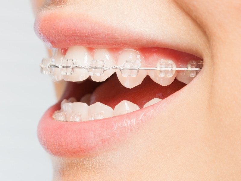 Are There Clear Braces Options? - Brimhall Dental Group Bakersfield  California