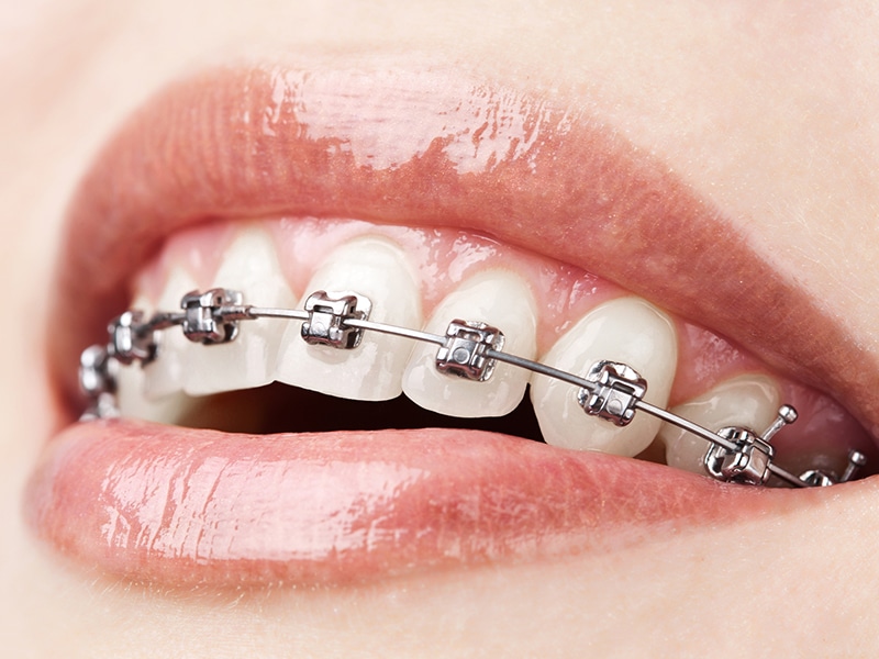 Metal Braces in Montgomery, TW Orthodontics, Enterprise Braces, Andalusia, Prattville Braces